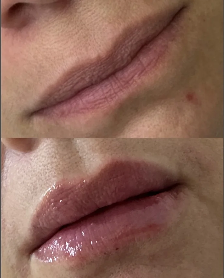 Labios antes y después del perfilado y aumento de volumen