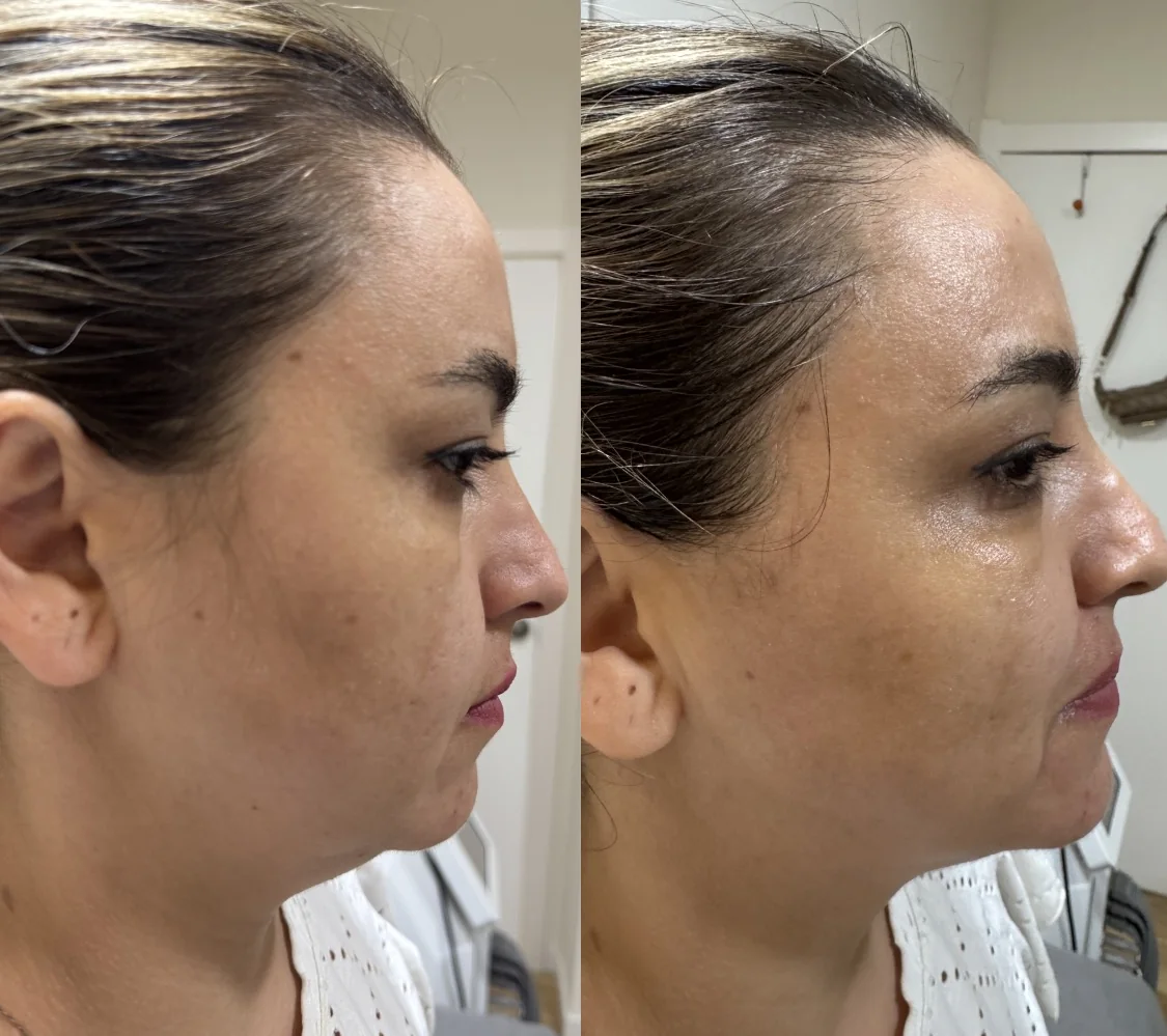 Perfil del rostro antes y después del tratamiento de firmeza