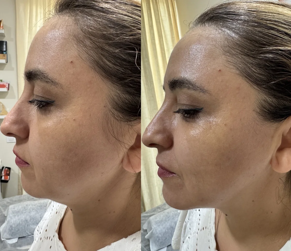 Mandíbula y cuello antes y después del tratamiento de firmeza