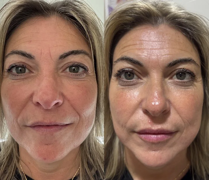 Comparativa de rostro antes y después tomada en consulta