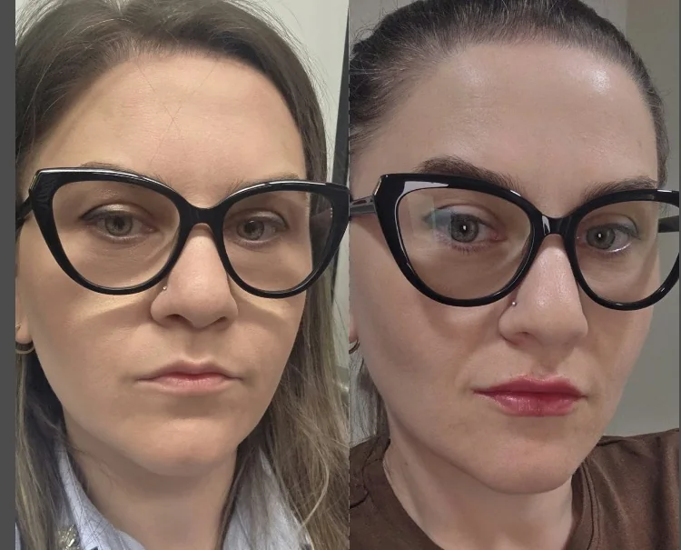 La misma clienta fotografiada antes y después del tratamiento