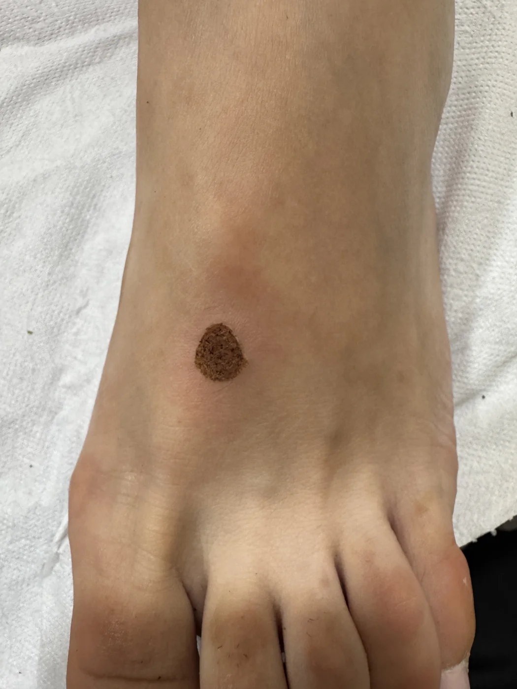 Costra sobre el dorso de la mano durante la cicatrización