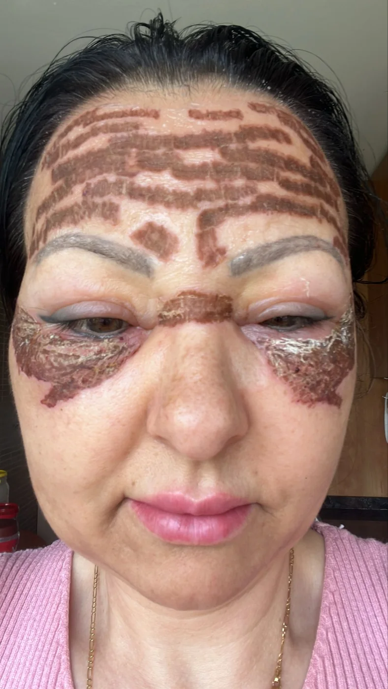Rostro durante la cicatrización del plasma, con costras en frente y contorno de ojos