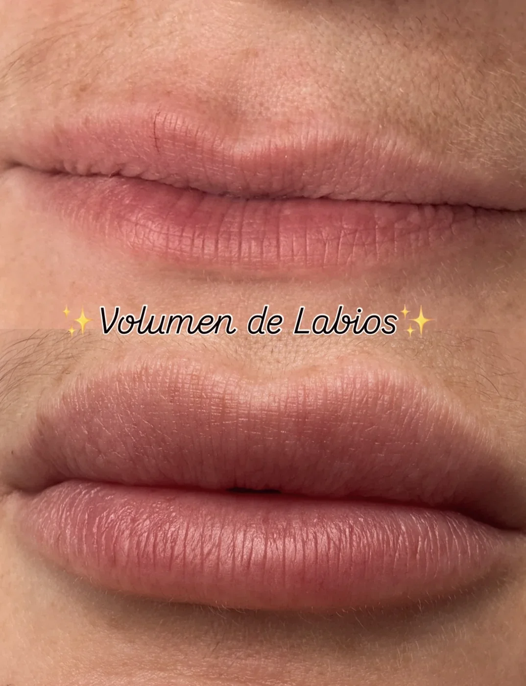 Labios tras el tratamiento, respetando el contorno natural