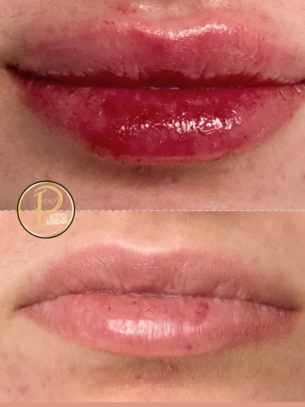 Labios con aspecto jugoso tras el tratamiento de hidratación