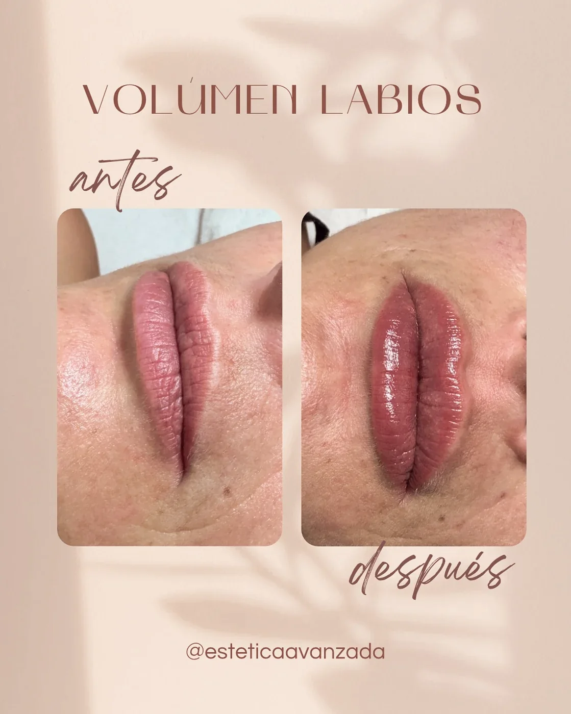 Labios antes y después del tratamiento de labios